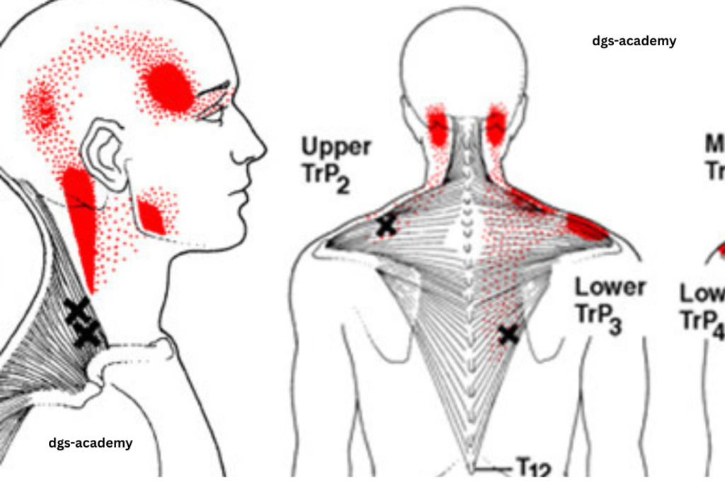 Trapezius trigger point location and referred pain pattern showing how neck tension can cause headaches and radiating arm pain.
