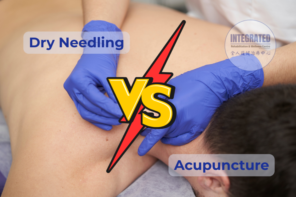 Comparison of dry needling and acupuncture techniques performed on the shoulder region, highlighting differences between Western trigger point therapy and traditional Chinese practice.