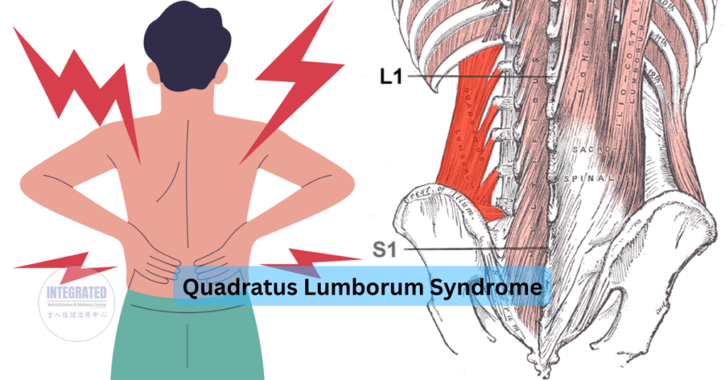 Illustration showing quadratus lumborum syndrome, highlighting lower back pain and the location of the quadratus lumborum muscle.